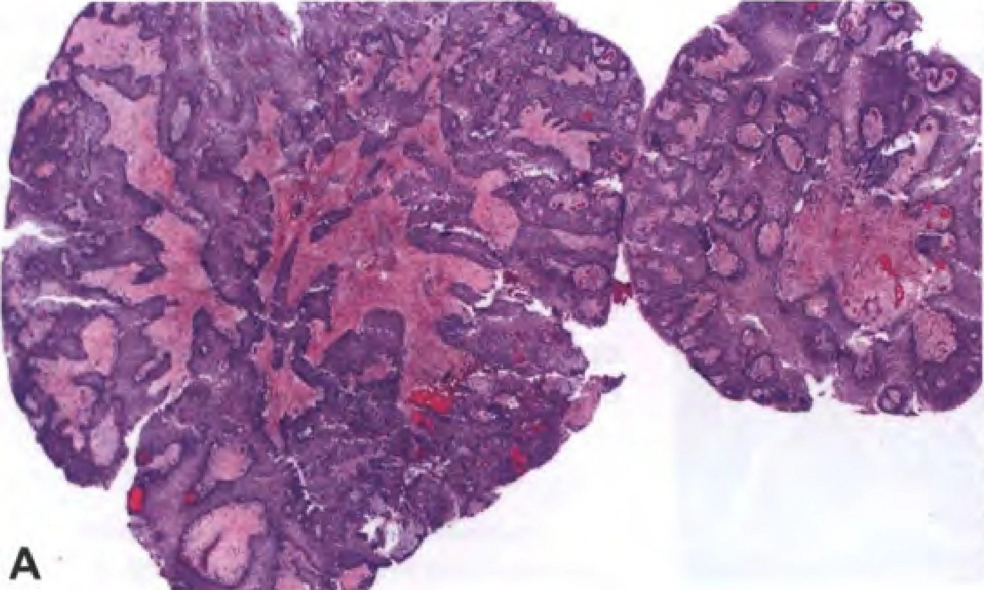 At low magnification, the tumour has a cauliflower-like appearance, with surface epithelium covering central fibrovascular cores.