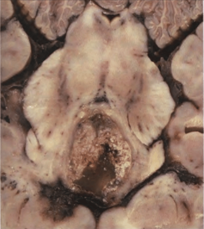 Adamantinomatous craniopharyngioma extending towards the cerebral peduncles; note the so-called machine-oil appearance of the dorsal portion and calcifications.