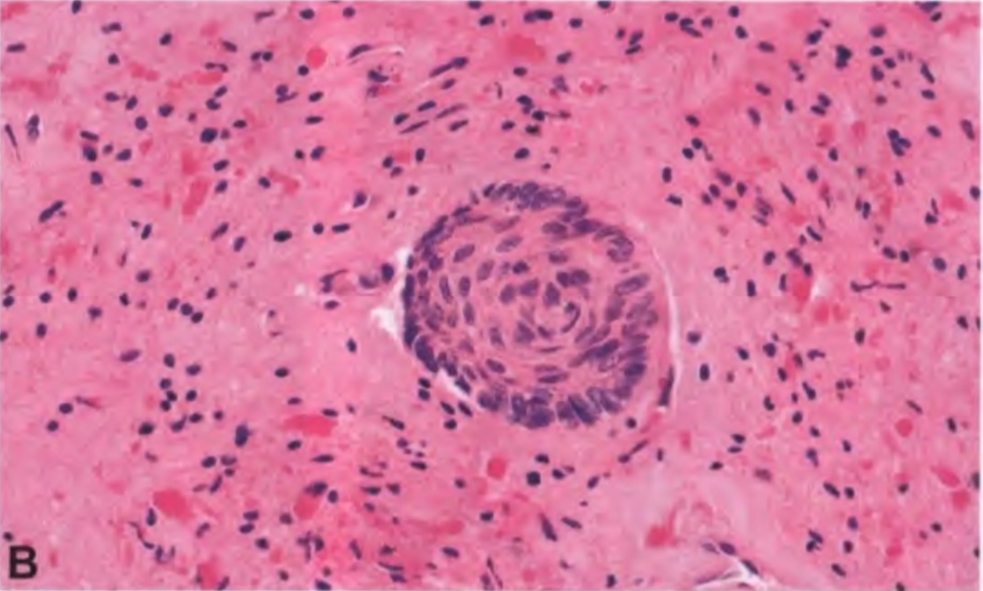 Cell groups of an adamantinomatous craniopharyngioma in the surrounding brain tissue, in which a distinct piloid gliosis with abundant Rosenthal fibres is evident.