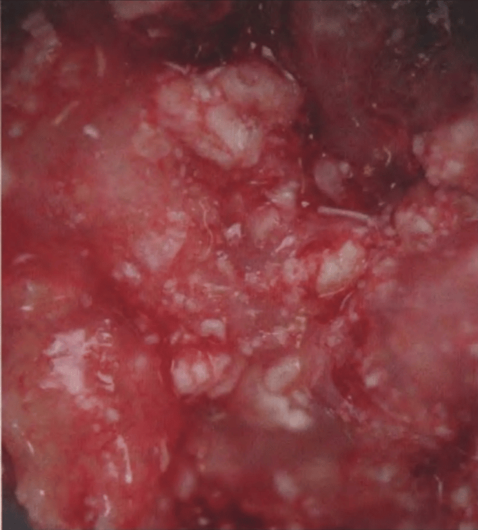 Adamantinomatous craniopharyngioma. Fresh tumour material showing an uneven surface with small calcifications and flakes of wet keratin (white deposits).