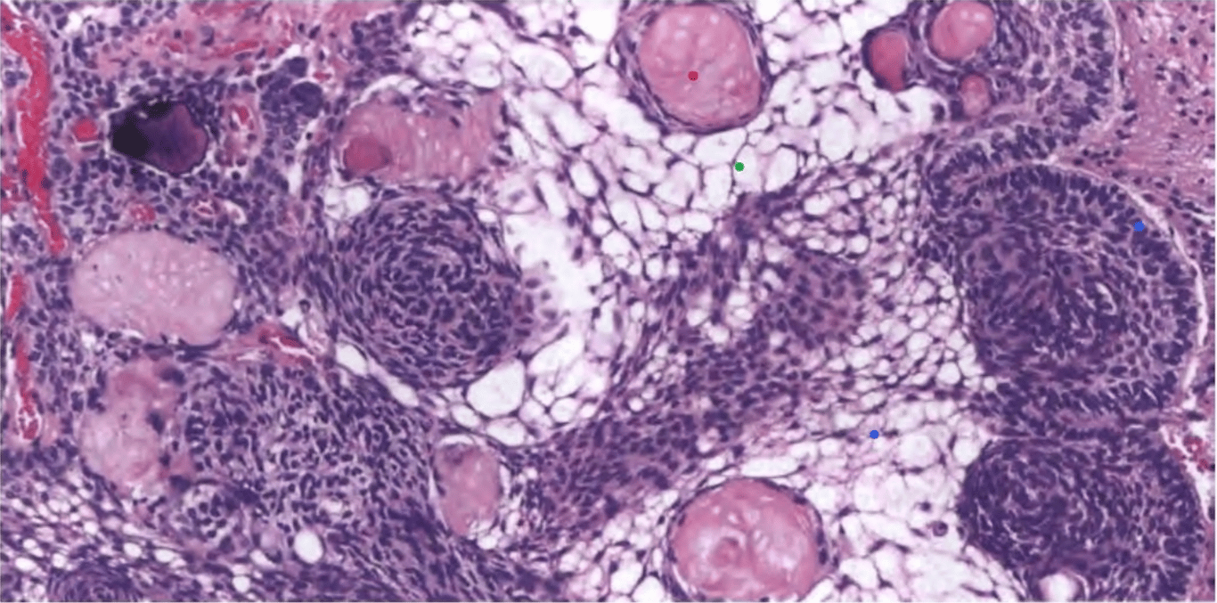 The distinctive epithelium features loose microcystic areas known as stellate reticulum (green dot), whorls, basal palisading (blue dot), and anucleate nests of pale, squamous ghost cells known as wet keratin (red dot).