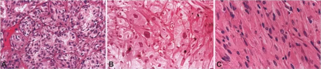 Fig. 17.23 Spindle cell oncocytoma. A Clear-cell appearance of the tumour cells arranged within a nested pattern. changes may be variable within a given tumour. B Some examples have pleomorphic nuclei. C Oncocytic 