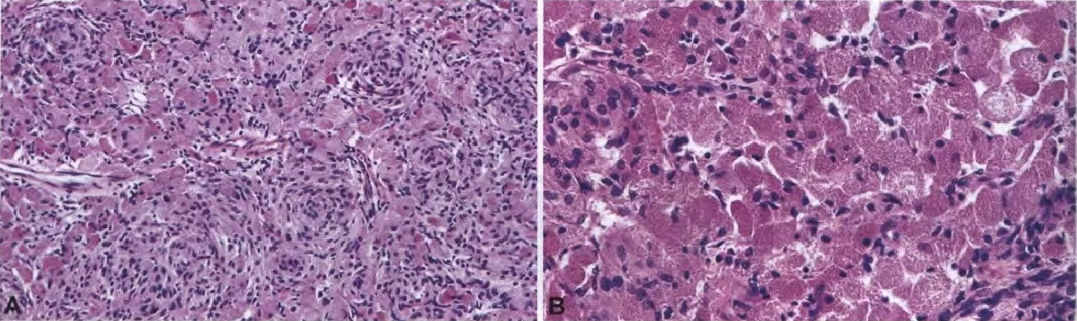 Fig. 17.15 Granular cell tumour of the neurohypophysis. A Spindled and whorled cellular architecture. B Characteristic abundant eosinophilic cytoplasm with prominent granularity. 