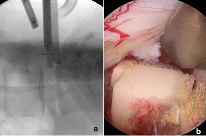 Impacting the cage into the disc space while protecting thecal sac by the retractor under the fluoroscopic (a) and endoscopic surveillance (b)