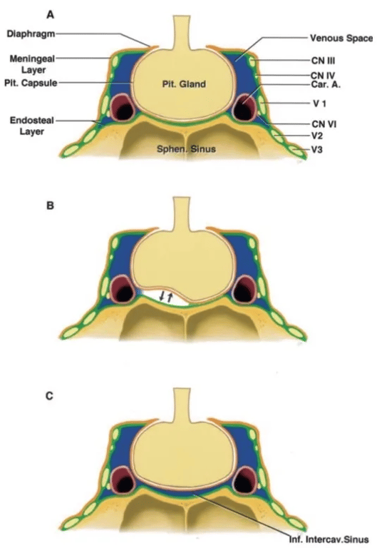 Diaphragm Meningeal Pit. Capsule Endosteal Layer c Pit Gland SphenSinus 6 Venous Space CN 111 N IV Car. A. VI CNVI f. Intercav.Sinus FIGURE 4. Diagrams illustrating coronal sections through the cavernous sinus and pituitary gland. A, diagram showing the dura divided into a meningeal layer (orange) and an endosteal layer (green). The two layers are tightly adherent in the floor of the middle cranial fossa, but on reach ing the upper edge of the second trigeminal division (V 2), which is the most inferior limit of the cavernous sinus, they separate into two layers. The meningeal layer extends upward to form the outer layer of the lateral wall and roof of the cavernous sinus and the upper layer of the dia- phragma sellae. The endosteal layer, at the level of the upper border of the maxillary nerve, divides into two layers. One layer extends upward to constitute the internal layer of the lateral wall and roof of the cavernous sinus, and the other one adheres to the sphenoid bone, covering the carotid sulcus and the sellar floor. From the free edge of the diaphragma, a thin layer of dura extends downward to wrap around but is easily separable from the pituitary gland. Our dissections suggest that the meningeal layer forms the sellar part of the medial wall of the cavernous sinus and that the endosteal layer (green layer) forms the sphenoidal part of the medial wall. The meningeal and endosteal layers of dura fuse into a single layer on the sellar floor. B, diagram illustrating that it is easy to separate the menin- geal layer covering the inferior aspect of the pituitary gland from the endosteal layer covering the bony sellar floor. C, diagram illustrating an inferior intercavernous sinus that connects the paired cavernous sinuses. These intercavernous sinuses extend across the midline between the men- ingeal dural layer covering the inferior aspect of the pituitary gland and the endosteal layer covering the osseous sellar floor. A., artery; Car., carotid; CN, cranial nerve; Inf., inferior; Intercav., intercavernous; Pit., pituitary; Sphen., sphenoid (from, Yasuda A, Campero A, Martins C, Rhoton AL Jr, Ribas GC: The medial wall of the cavernous sinus: Micro- surgical anatomy. Neurosurgery 55:179—190, 2004 [50]). 