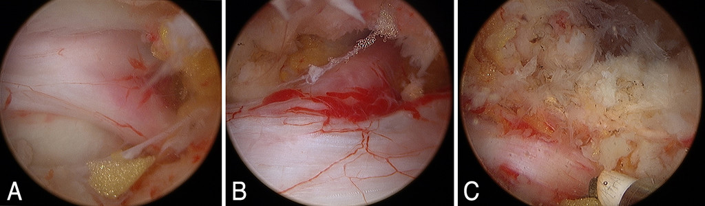 complete decompression status of the ipsilateral left side traversing the nerve root of L5 (A), the contralateral right side traversing the nerve root of L5 (B), and the ipsilateral left side exiting nerve root of L4 (C).