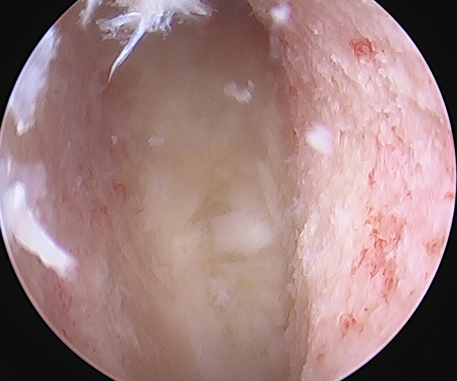 This intraoperative endoscopic image shows complete endplate preparation without injury to the osseous endplate.