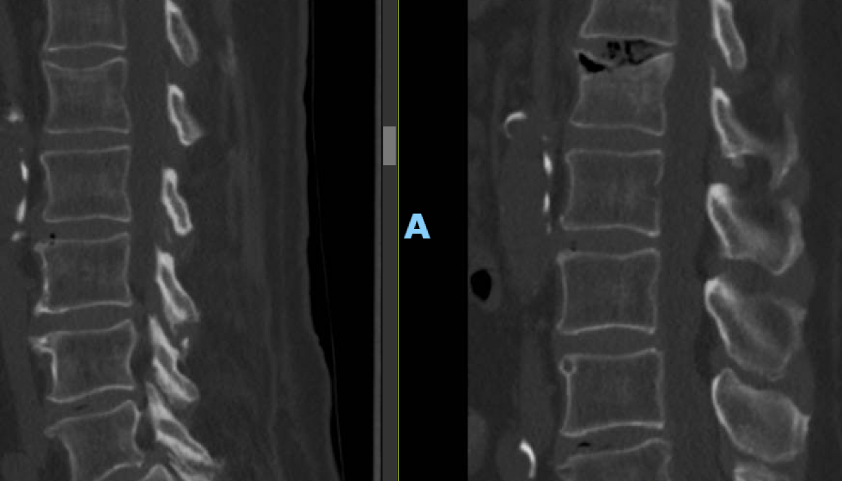 Figure 1: Octegenarian male with a L1 compression fracture with < 25% VHL managed conservatively re-presented one month later with Kummel disease. 