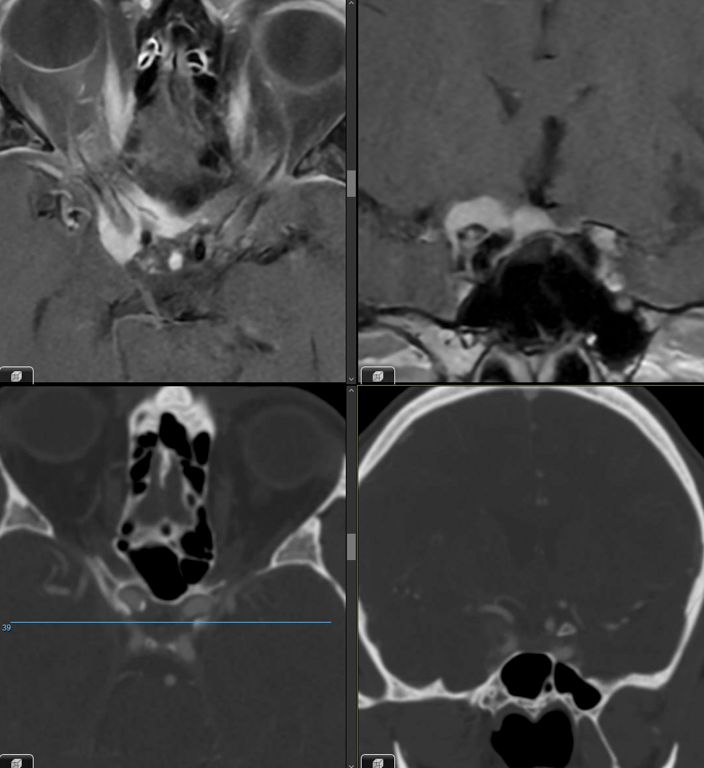 Middle aged adult with an extra-axial mass along the right anterior clinoid process with encasement of the para-clinoidal internal carotid artery. 