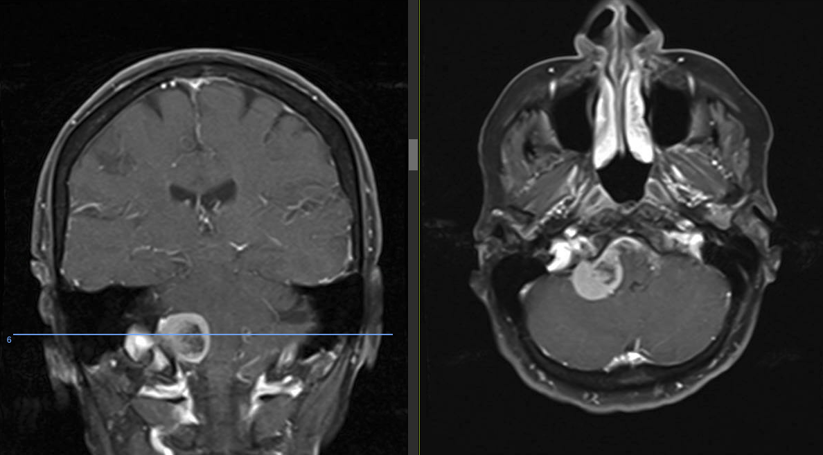 Elderly female with progressive imbalance was found to have a large meningioma of the foramen magnum/jugular tubercle with obvious brainstem compression. This was resected with a Right far lateral approach with extended trnasmastoidi approach with duraplasty.