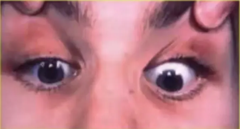 - Normal downgaze
- Convergence weakness
- Convergence-retraction nystagmus