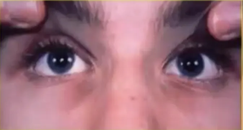 - Supranuclear upgaze palsy
- Large pupils with light-near dissociation
- Lid retraction (Collier sign)