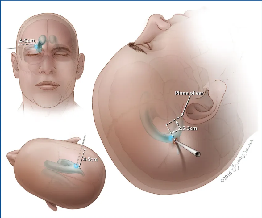 FIGURE 6. Ventricular access via Keen's point. After a burr hole is placed 25 cm superior and posterior to the pinna Of the ear, the catheter should be placed perpendicular to the cortex and aimed in a slight cephalic direction. The catheter should be advanced 4 to 5 cm or until the trigone of the ipsilateral lateral ventricle is reached. (02016 Elizabeth IV. Weissbrod. Used' with permission. 