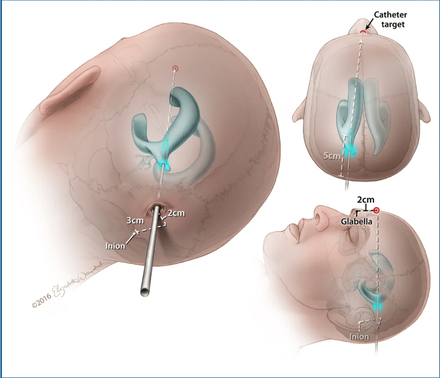 2r-1JJ 3cm Inion Catheter target 5cm , 2cm Glåbella Inion FIGURE 8. Ventricular access via Dandy's point. From an occipital approach, a burr hole is created 3 cm above the inion and 2 cm lateral to the midline. The catheter is directed toward a point 2 cm above the glabella and passed 4 to 5 cm or until the body of the ipsilateral lateral ventricle is reached. 