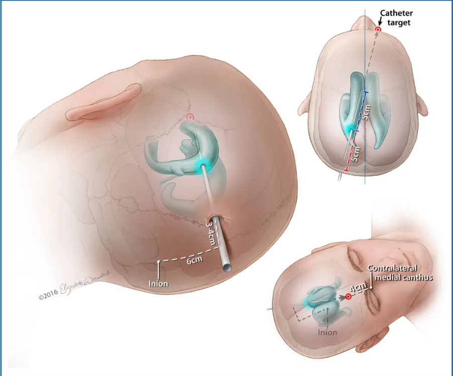 ¯ ¯6cm Catheter target ninth' Inion Inion FIGURE 7. Ventricular access via Frazier's point. From a parietal approach, the burr hole should be above and lateral to the lambdoid suture at a location that is 6 cm superior to the inion and 3 to 4 cm lateral to the midline. The catheter is directed to a point that lies 4 cm above the contralateral medial canthus and passed 5 cm or until CSF is encountered. The catheter stylet is then removed, and the catheter is soft-passed an additional 5 cm, placing it within the body of the ipsilateral lateral ventricle. 02016 Elizabeth N. Weissbrod. Used with permission. 