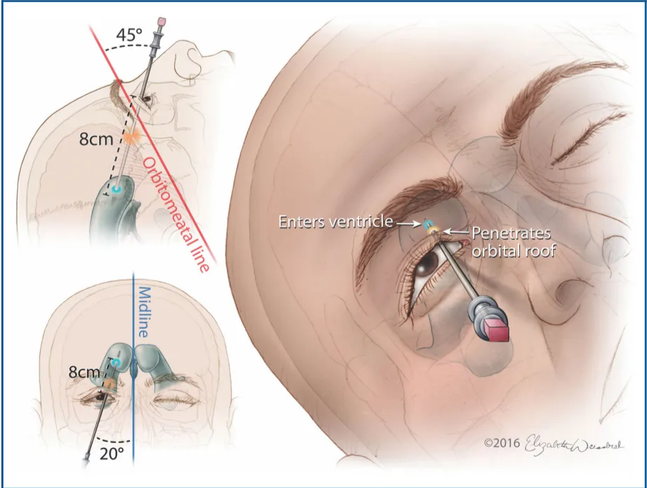 450 8cm , 200 Enters ven a 02016 FIGURE 5. Ventricular access via Tubbs' point. The spinal needle should be placed under the upper eyelid medial to the midpupillary line and advanced at a trajectory that is 450 superior to the orbitomeatal line and' 2m toward the midline. As the needle is advanced, the orbital roof should be encountered and penetrated. The needle should be passed to a depth of approximately 8 cm or until the frontal horn of the ipsilateral lateral ventricle is reached. (02016 Elizabeth N. Weissbrod. Used with permission. 