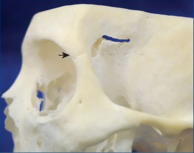 1 FIGURE 3. Left cranial view noting the frontozygomatic suture (arrow) and the exit site of drill holes that have been placed from the upper outer aspect of the orbit (single lower hole) and from the floor of the anterior cranialfossa (4 horizontal holes). 