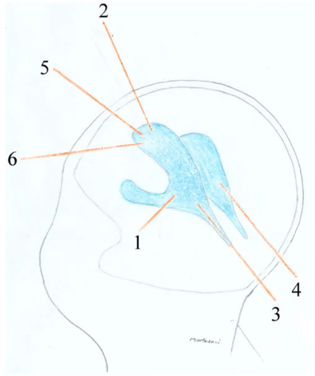 Fig. 3 Schematic illustration of all the extra-calvarial ventricular access points: I Keen, 2 Kocher, 3 Dandy, 4 Frazier, 5 Kaufinan, and 6 Tubbs 