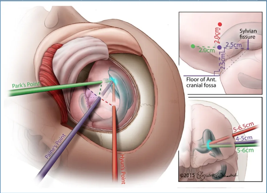 Park's Point Sylvian fissure 2.5cm •2.Grn- - - Floor of Ant. cranial fossa 5-6cm 01 FIGURE3. Ventricularaccess via Paine's, Hyun's, andPark'spoints. Ventricularaccessshouldonlybeattemptedafiercompletion of a frontotemporal craniotomy. For Paine's point, the ventricular catheter should enter the brain at a location that is 2.5 cm above thefloor of the anterior cranial fossa and 2.5 cm anterior to the sylvianfissure. The catheter should be passedperpendicular to the convexity of the brain surface and advanced to a depth ofapproximately 4 to 5 cm or until the frontal horn of the ipsilateral lateral ventricle is reached. For Hyun's point, the ventricular catheter should enter the brain at a location that extends 2 cm from the anterior limb of Paine's triangle (4.5 cm above the floor of the anterior cranial fossa). The catheter should be passed perpendicular to the convexity of the brain surface and advanced go a depth of approximately 5 to 6.5 cm or until the frontal horn of rhe ipsilateral lateral ventricle is reached. For Park's point, the ventricular catheter should enter rhe brain at a location that extends 2 cm from the posterior limb of Pain/s triangle (4.5 cm anterior to the sylvian fissure). The catheter should be passed perpendicular to the convexity of the brain surface and advanced to a depth of approximately 5 to 6 cm or until the frontal horn of the ipsilareral lateral ventricle is reached. 02015 Elizabeth N. Weissbrod. Used with permission. 
