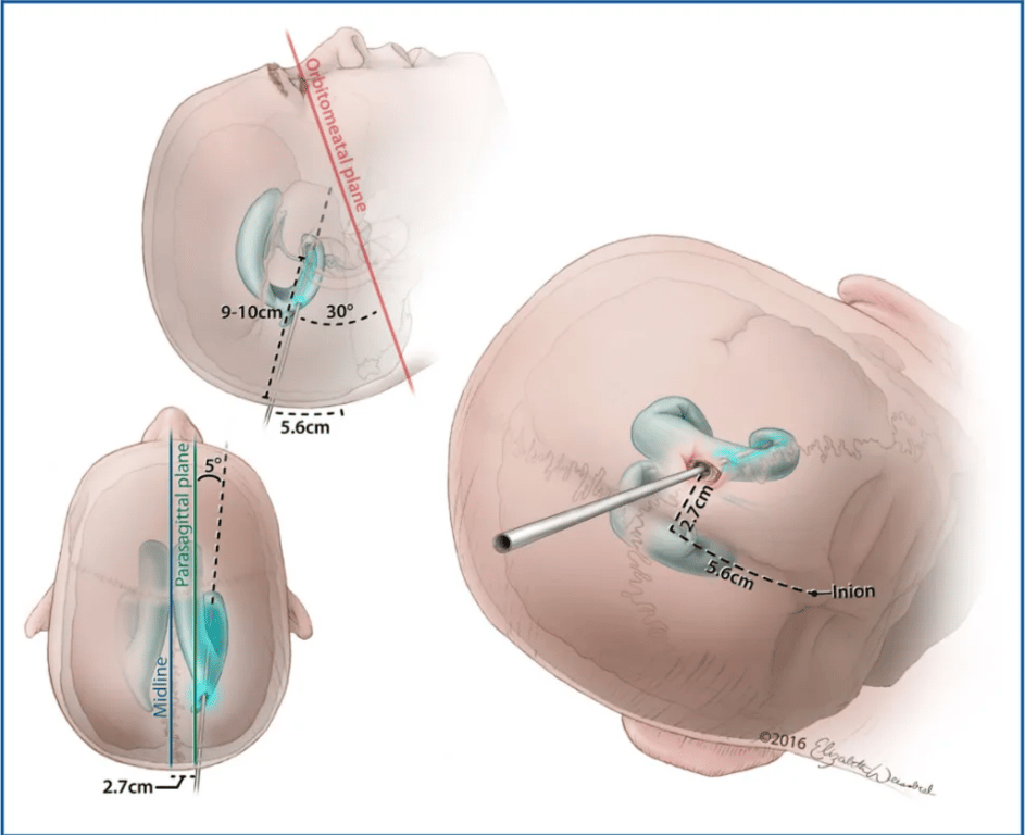 5 .öca 2.7cm—7 FIGURE 9. Ventricular access via Sanchez's point. A burr hole is placed 5.6 cm above the inion and 2.7 cm lateral to midline. The catheter is angled 50 lateral to the parasagittal plane and 300 inferior toward the orbitomeatal plane. The catheter is then advanced 9 to 10 cm to be positioned within the temporal horn of the ipsilateral lateral ventricle. (02016 Elizabeth N. Weissbrod. Used with permission. 
