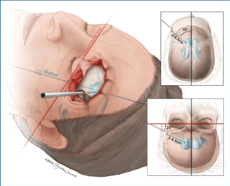 450 _ FIGURE 4. Ventricularaccess via Menovskys point. Afterdrillingthekeyhole burrhole through the bone duringa supraorbital craniotomy and incising the dura, the ventricular catheter should be passed at an angle that is 450 toward the midline and 203 superior to the orbitomeatal line. The catheter should be passed to a depth of approximately 5 to 6.5 cm or until the frontal horn of the ipsilateral lateral ventricle is reached. 02016 Elizabeth N. Weissbrod. Used with permission. 