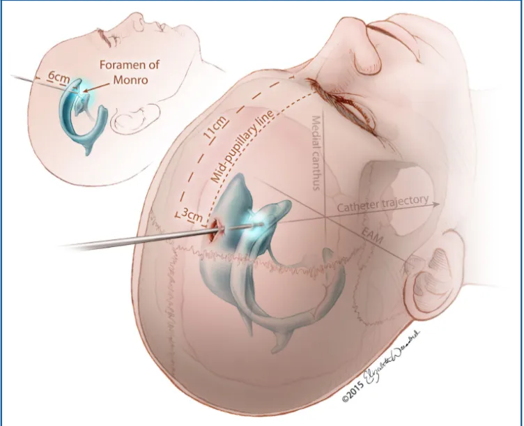 écth Foramen of Monro Catheter tra-ectol FIGURE l. Ventricular access via Koc-her's point. The bum hole should be placed I I cm superior and posterior m rhe nasion and3 cm lateral to the midline, Next. the ventricular catheter should be aimed at an angle that is perpendicular to the intersection Of the medial the (EAM). The catheter be passed ro a dept/' of apprm-imarely 6 cm or until rhefrontal horn of rhe ipsilareral lateral ventricle i' reached. @2015 Elizabeth N. Weissbrod. Used with permission. 