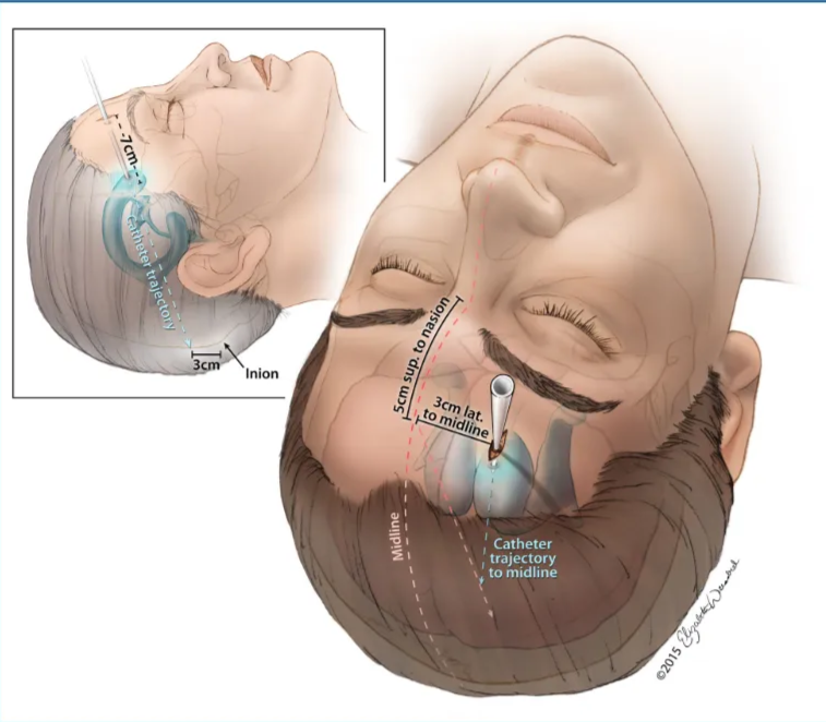 , Catheter trajectory to midline FIGURE 2. Ventricular access Kaufman's point. The burr should be 5 cm superior to the nasion and 3 em midline. Next, toward 'o a point is 3 cm superior m the inion. The catheter should be passed ro a depth of approximately 7 cm or until the frontal horn of 'be ipsilateral lateral ventricle is reached 02015 Elizabeth N. Weissbrod. Used with permission. 