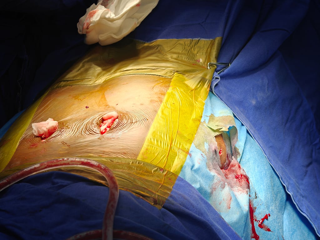 Bilateral paramedian incision made according the II to plan L5 screw entry as per MIS technique. Extend incision caudally so that the PSIS can be exposed. The left lateral stab incision is made based on II for the ilio-sacral screw. 