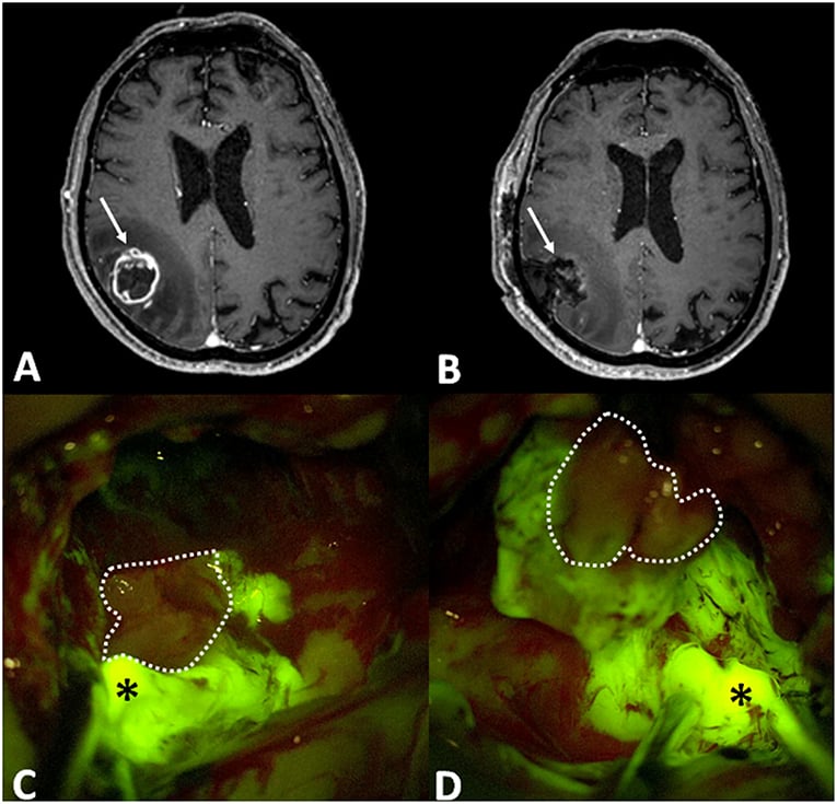 Frontiers | Fluorescein Application in Cranial and Spinal Tumors Enhancing at Preoperative MRI and Operated With a Dedicated Filter on the Surgical Microscope: Preliminary Results in 279 Patients Enrolled in the FLUOCERTUM