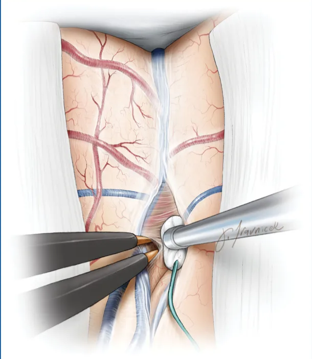 FIGURE 8. Step l. The superficial fissure is dissected open the level Of the Sylvian point Where the interopercular S/utce through the arachnoid band is most prominent. This dissection is extended to the level b•f2 branches and insula. Note the use Of the small cotton pledget discussed above. Used With permission from Neurosurgical Atlas by Aaron Cohen-Gail, MD. 