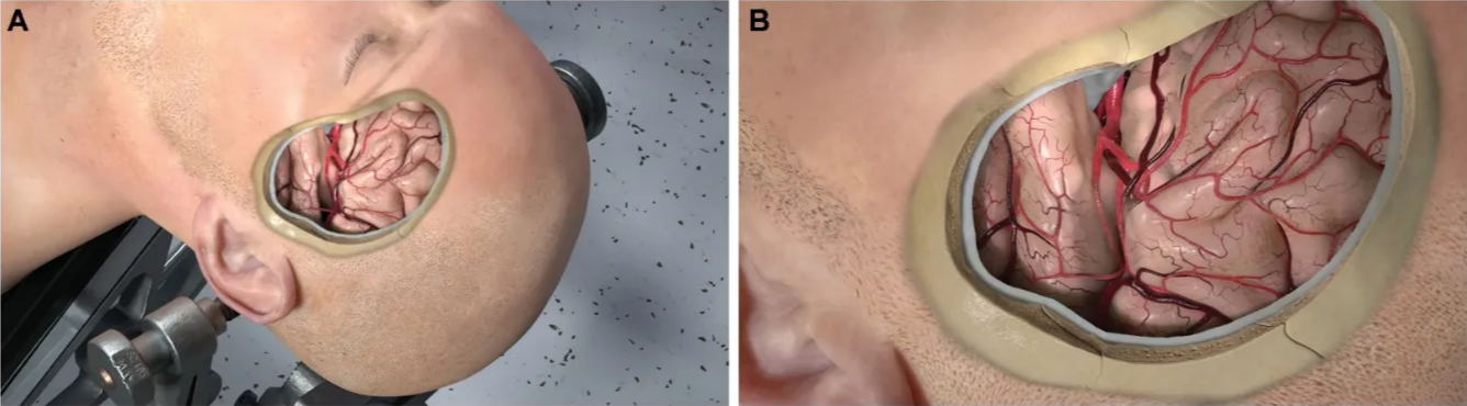FIGURE 5. A transparent view of the fissure and its orientation relative to the skull and head position is demonstrated far A and closeup B views). Used with permission from Neurosurgical Atlas by Aaron Cohen-Gadol, MD. 