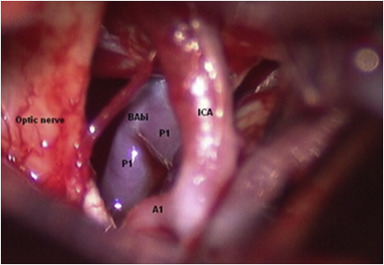 Visualisation of basilar artery after opening the membrane of liliequist.