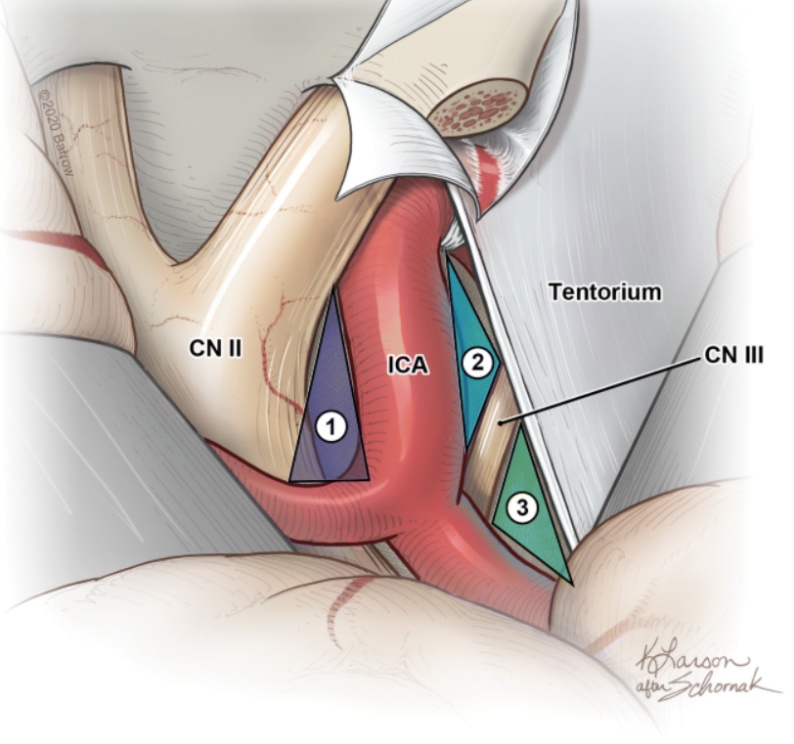 CN Г АСА 2 Tentorium CN 