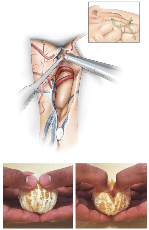 FIGURE 7. The Sylt.'ianfissure is split using the inside-to-outside technique. The dissection is started at rhe Sylvian point and extended 'o rhe depth of the fissure $0 that one can identify distal MCA branches on the surface Of the Next, rhe dissection continues from deep to superficial (upper image, inset, arrows). This method of opening the fissure has an analogy: Yasargil compared this method to radial Splitting of peeled orange wedges. Ir is difficult m separate the edges from the outside lower image), bur it is easy put rhe finger into the middle Of the orange and radially separate the wedges (right lower image). Used with permission from Neurosurgical Atlas by Aaron Cohen-Gadol, MD. 