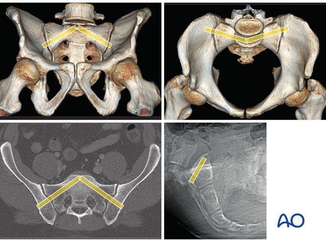 The yellow “tubes” superimposed on outlet and inlet 3D CTs show typical channels for SI joint fixation – perpendicular to the plane of the SI joint.