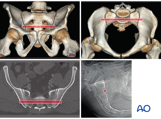 These images illustrate the channel for an S2 transsacral screw in a normal pelvis. 
This screw can supplement a standard SI joint screw, if required.