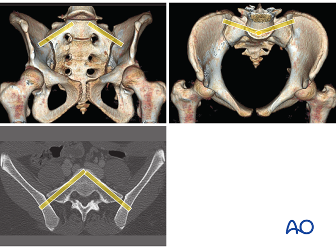 In some cases, ISS can be inserted into a dysmorphic first sacral segment, using increased caudal to cranial and posterior to anterior angulation. 
Note the narrowness of the safe passage through the sacral ala at this level, with the channel close and parallel to the anterior cortex, to avoid entering the spinal canal.