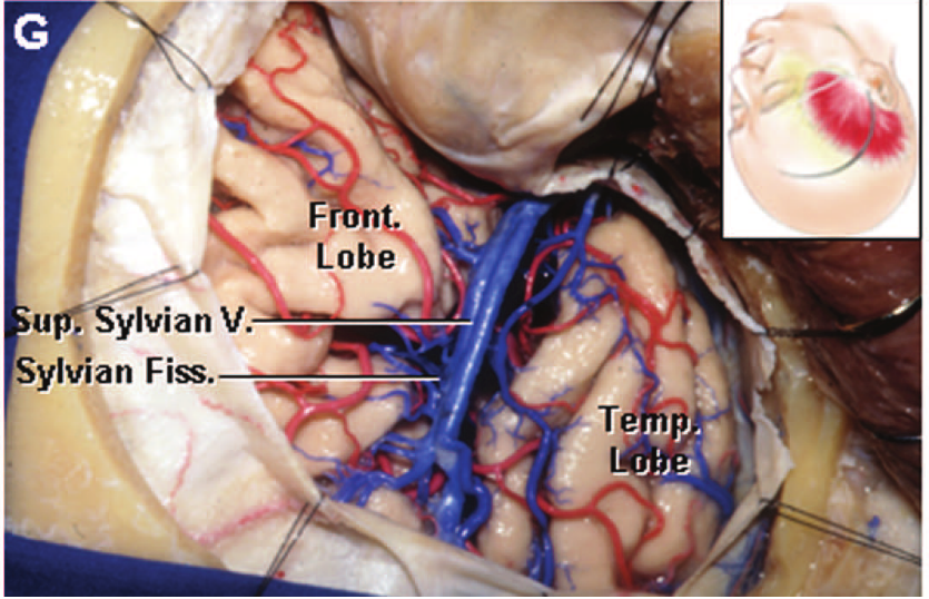 Lobe upt Sylvian V. ylvian Fiss. 