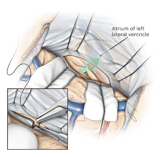 Figure 16: If the contralateral hemisphere must be accessed, I make a T-shaped incision within the falx and reflect the falcine flaps using stay sutures (inset image). This cross-court trajectory (green arrow) expands the lateral operative angles. The above sketch shows the posterior interhemisperic transfalcine transprecuneus approach for reaching lesions within the atrium.