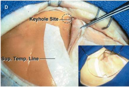 hole Site . Temp. Line 