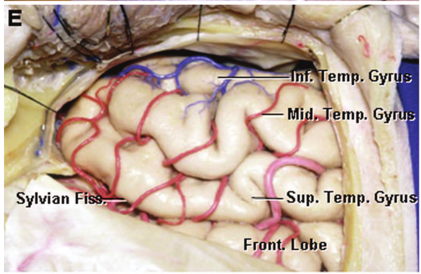 Mi em . Gyr emp. Gyi Sylvian Sup. Te p. Gyru Fr 