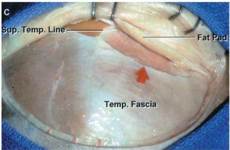 . Temp. Li Temp. Fascia 