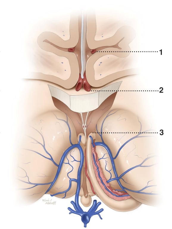 Figure 2: A coronal non-operative view of the surgical trajectory for the interhemispheric corridor toward the midline deep surgical targets is demonstrated. Important landmark structures include the cingulum (1), corpus callosum (2) and fornices (3). The cerebrovascular structures in each dissection level should be carefully preserved. The diencephalic deep veins are of special importance to avoid surgical morbidity.