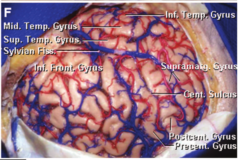 Gyrus Mid. Temp. Sup. Te syl ru upr a rus Gyrus Pre 