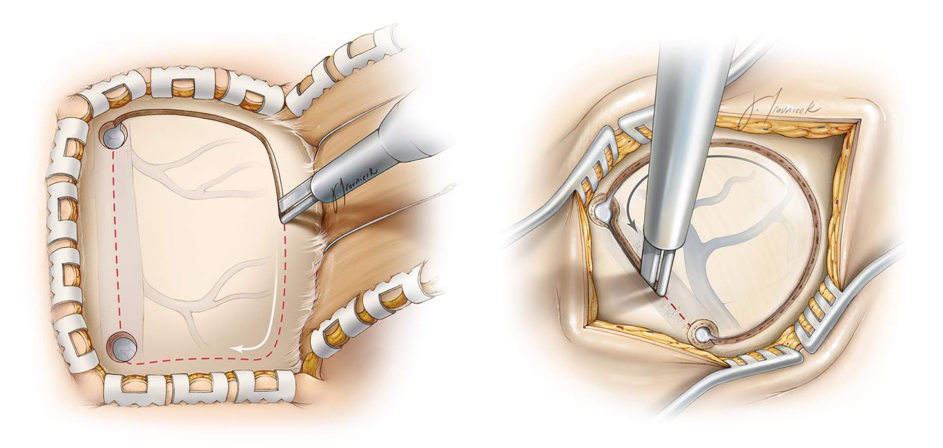 Figure 9: After I complete two burr holes over the sinus, I use a #3 Penfield dissector to generously separate the dura from the inner table of the calverium underneath the craniotomy and especially over the sinus. The final bone cut is made along the sinus to allow timely elevation of the flap if injury to the sinus occurs. Large strips of surgicel or gelfoam should be available to cover the sinus for hemostasis. Cerebrospinal fluid drainage through the lumbar drain allows the sinus and dura to fall away from the inner table of the skull and prevents unintentional sinus injury or durotomies.