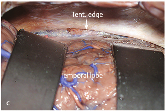Close-up of a blood vessel AI-generated content may be incorrect.