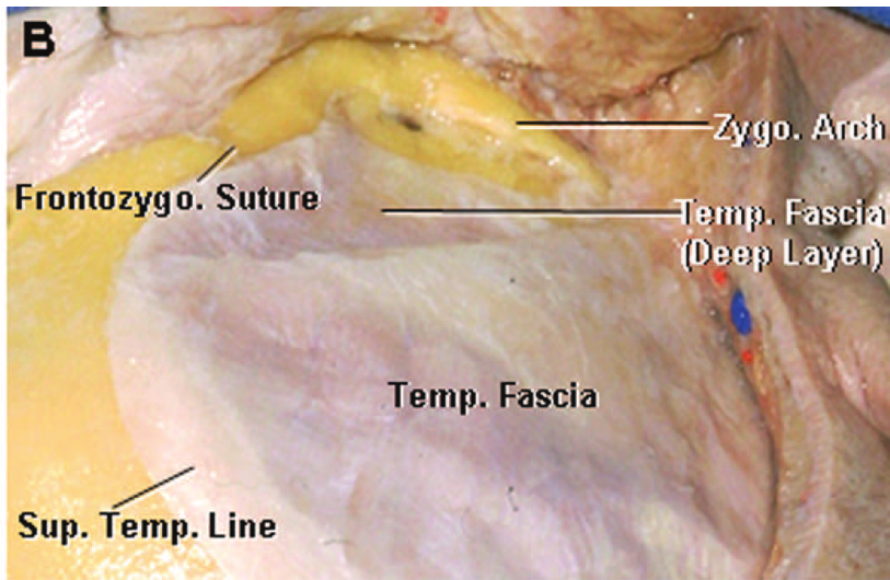 zy 0. A Frontozygo. Suture we 'Lay Temp. Fascia Sup. Temp. Line 