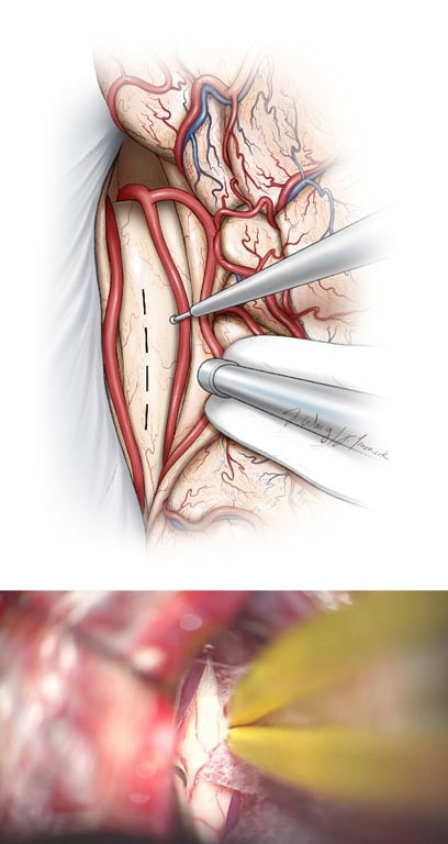 Figure 13: The corpus callosum is widely exposed in the midline between the paired pericallosal arteries. Adherent arachnoid membranes of the cingula are sharply and widely split anteriorly and posteriorly to minimize retraction on the medial hemispheres. At times, pericallosal arteries may be displaced to one side or they may also adhere together, making their separation difficult.