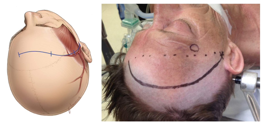 Reflection of the scalp flap to allow adequate exposure of the keyhole area, a straight line (hashed line) connecting the two ends of the incision should remain within 1cm distance of the keyhole (marked as a circle) (right image).