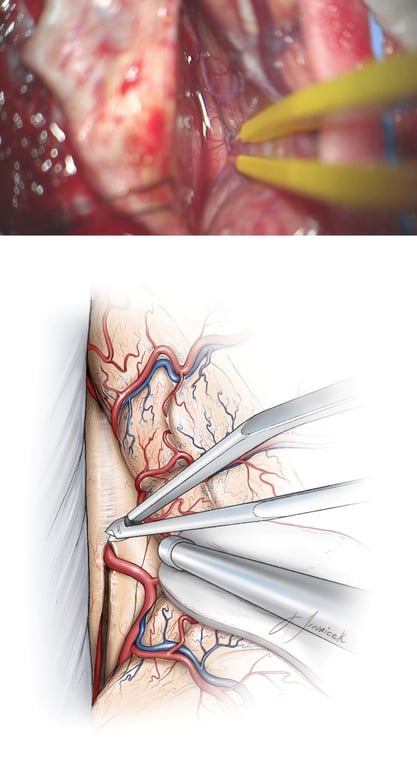 Figure 11: The subdural portion of the dissection is completed along the falx and the ipsilateral callosomarginal artery is traced along the midline to the level of the cingulum (top image). This artery will define the midline dissection planes so the surgeon can avoid subpial injury to the adherent cortices of the cingula through meticulous and sharp microsurgical techniques (bottom image).